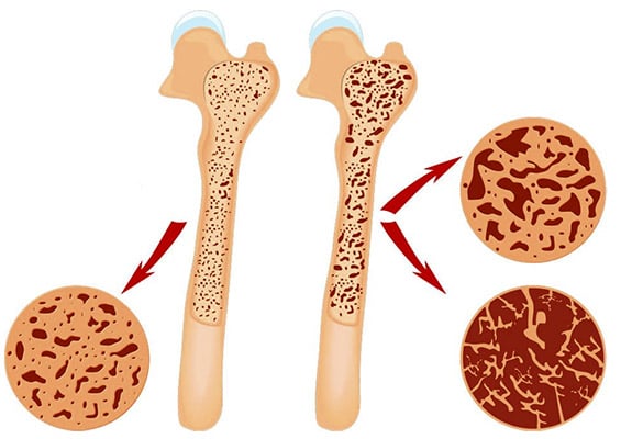 An illustration of a healthy and unhealthy bone density