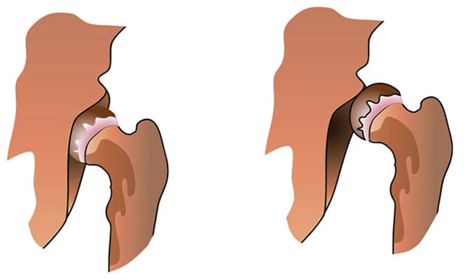 An illustration of a normal hip position and hip subluxation