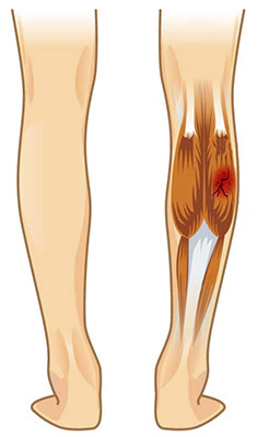 An illustration of leg muscle spasm and tension