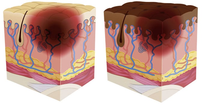 Two illustrations of skin with pressure ulcers